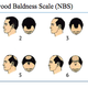 Image for article titled Economists figured out just how much men will pay to end baldness